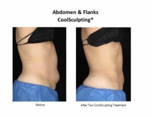 A before and after image shows the results of CoolSculpting on a female patient's abdomen and flanks from the side, revealing a much slimmer torso after two treatments.