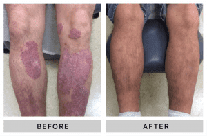 Before and After treating psoriasis