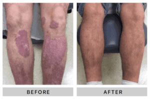 Before and After treating psoriasis