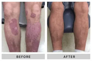 Before and After treating psoriasis