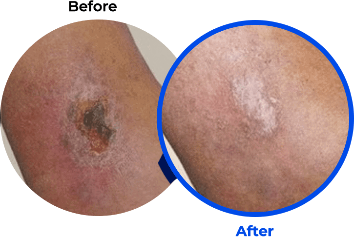 Leg Ulcer Before and After Photo