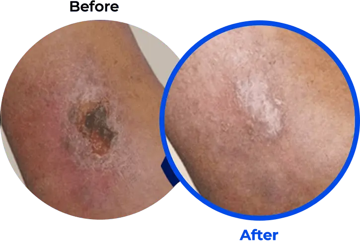 Leg Ulcer Before and After Photo