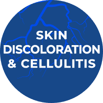 Skin Discoloration Cellulitis