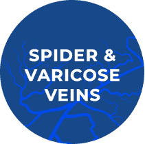 Spider Varicose Veins