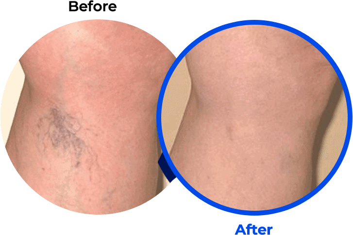 Spider Veins Before and After