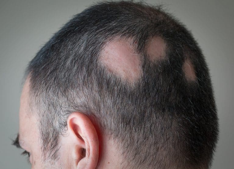 What Is Alopecia Areata and Could You Have This Autoimmune Hair Loss  Condition? - Riverchase Dermatology