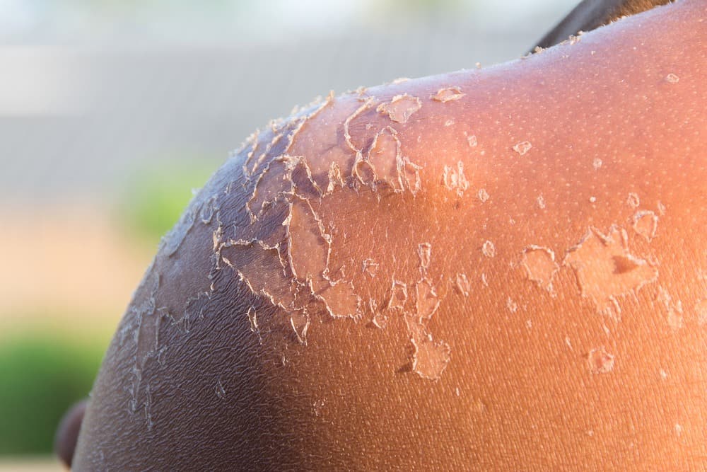 How to Get Rid of Peeling Skin from a Sunburn - Riverchase Dermatology