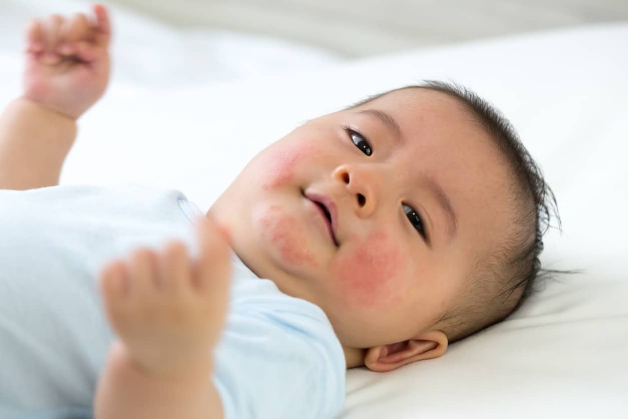 Asian baby with eczema rash on face