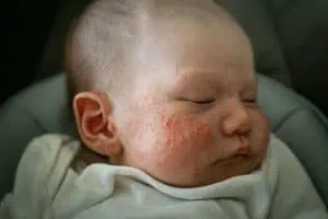 Baby acne