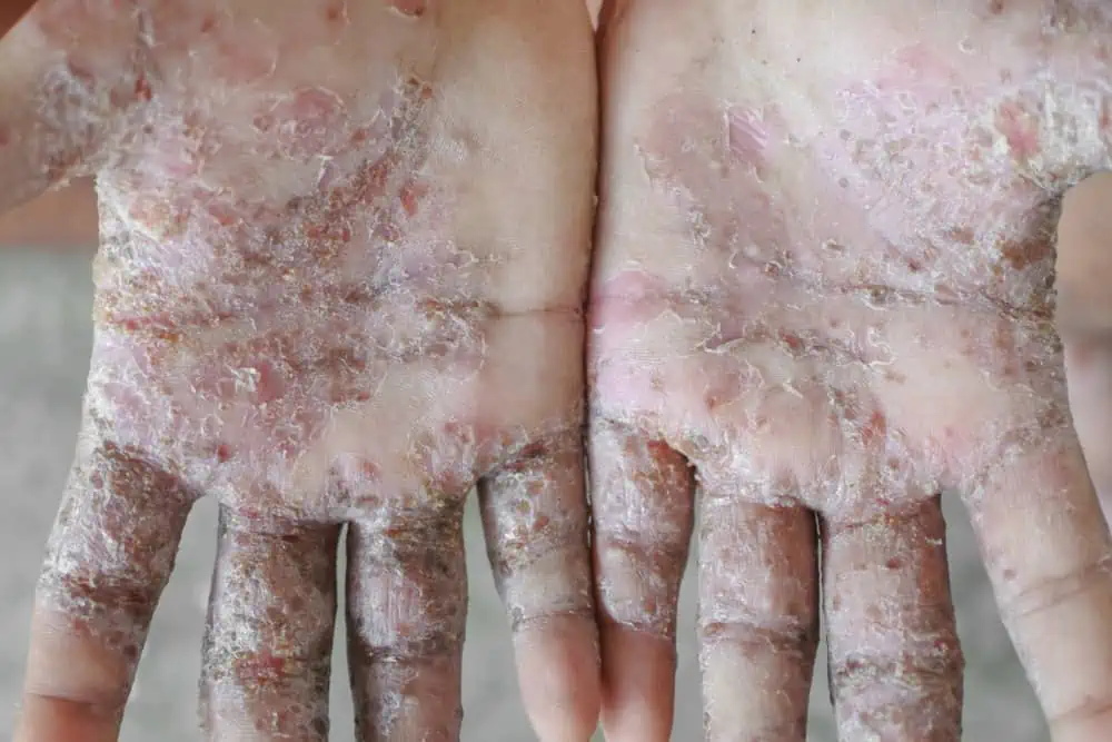 Crusted scabies, also called Norwegian scabies