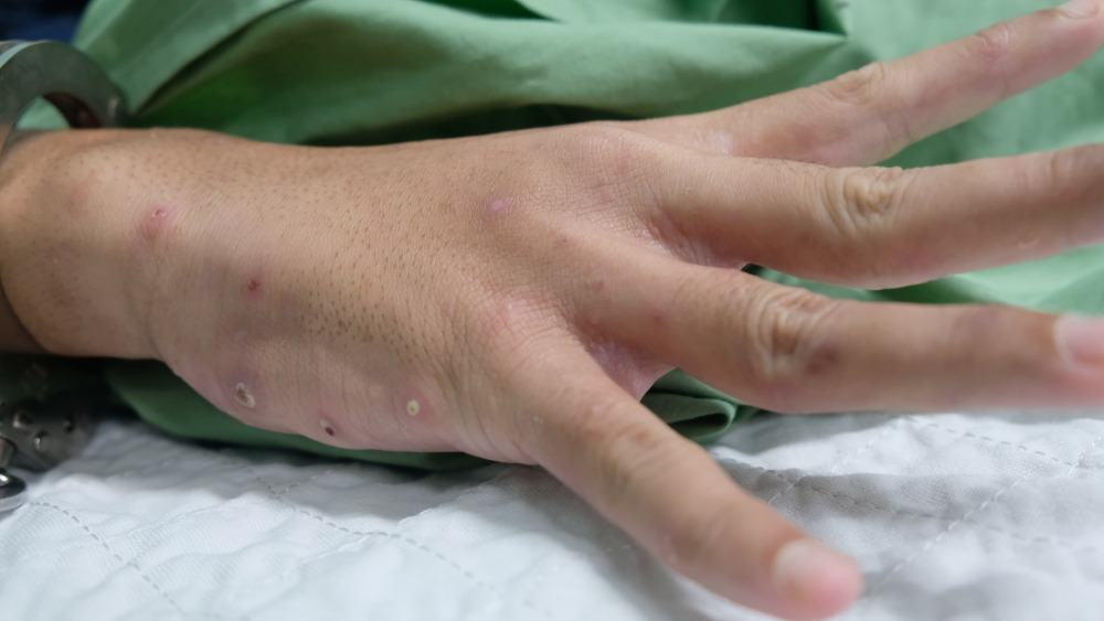 Infected scabies on a hand