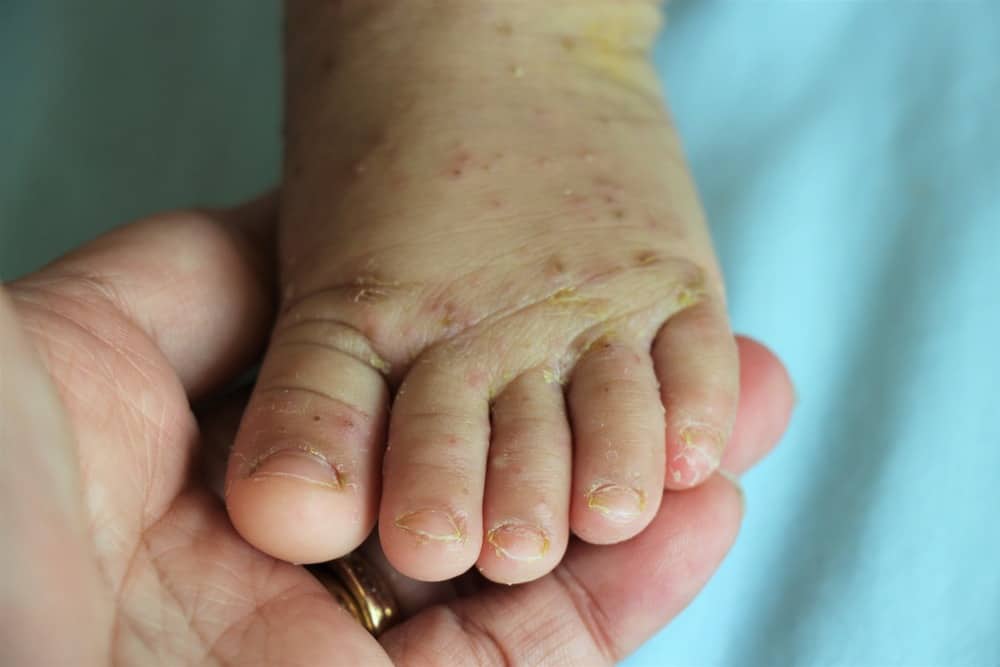 Scabies on a baby’s foot