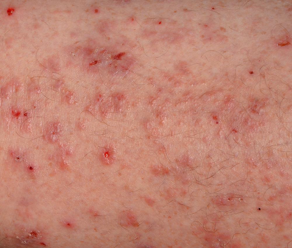 A closeup of a severe scabies rash