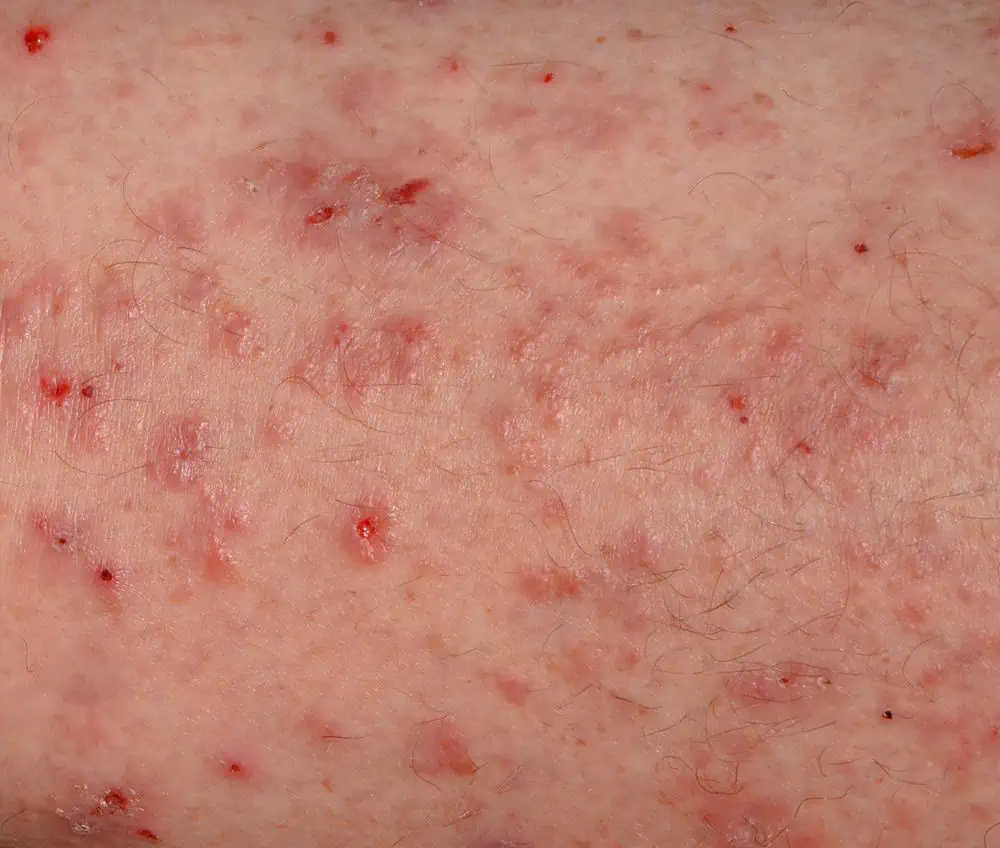 A closeup of a severe scabies rash
