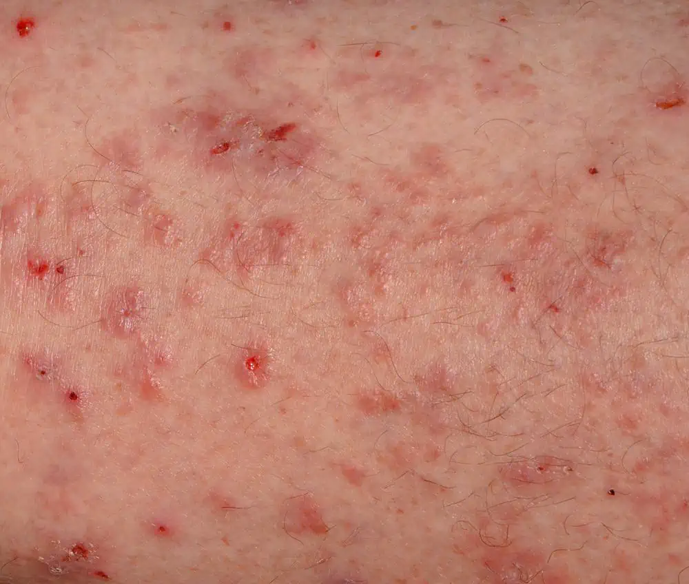 Scabies Rash on Black Skin: Symptoms and Treatment