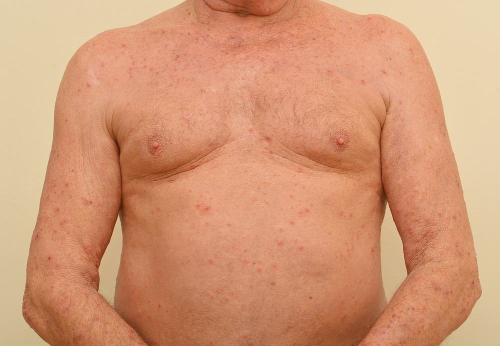 A man with widespread scabies