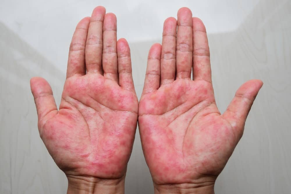 6 Types of Eczema: Which Do You Have? - Riverchase Dermatology