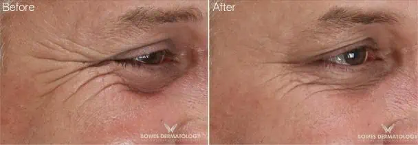 Xeomin Before and After - 2