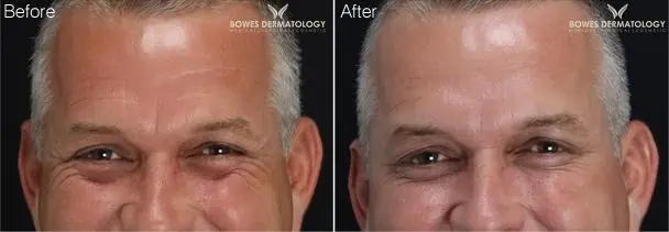 Xeomin Before and After - 6