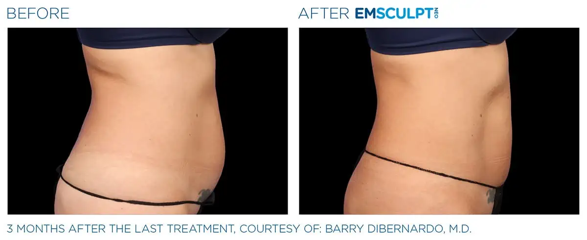 Emsculpt Before and After Photo #1