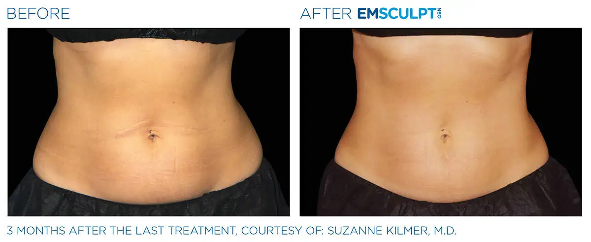 Emsculpt Before and After Photo #2