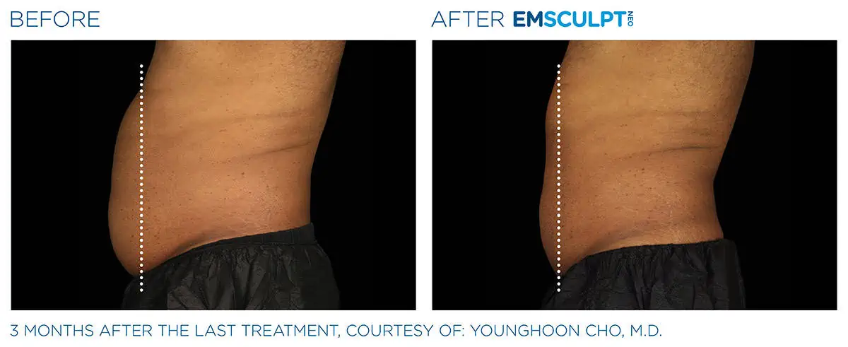 Emsculpt Before and After Photo #4