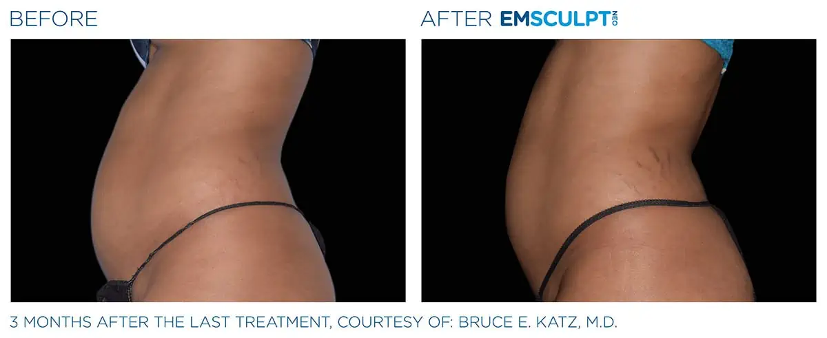 Emsculpt Before and After Photo #5