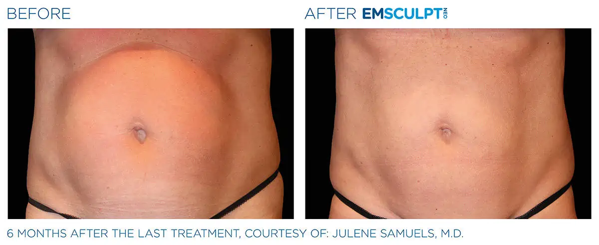 Emsculpt Before and After Photo #6