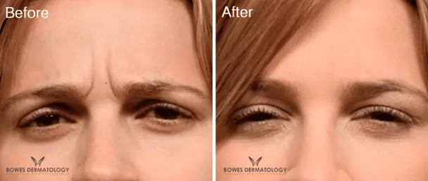 Botox Before and After - 7