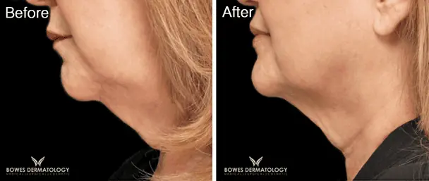 Botox Before and After - 2