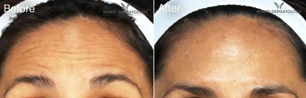Botox Before and After - 4