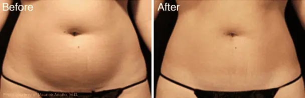 Velashape Before and After - 1