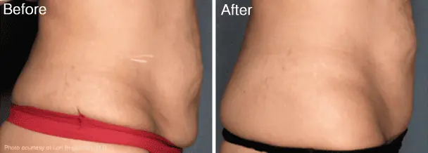 Velashape Before and After - 2