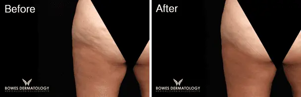 Velashape Before and After - 4
