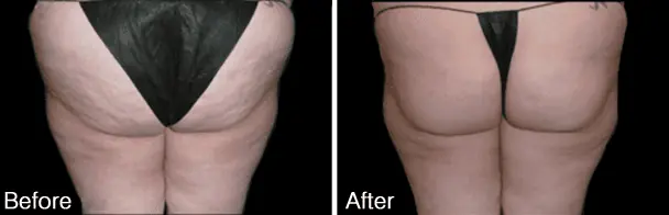 Velashape Before and After - 5