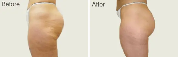 Velashape Before and After - 6