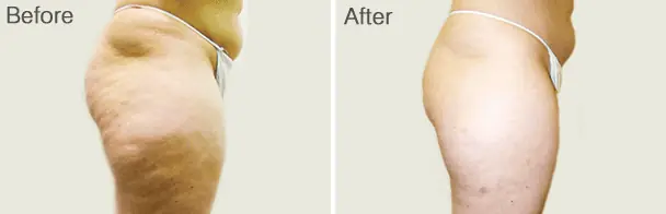 Velashape Before and After - 7