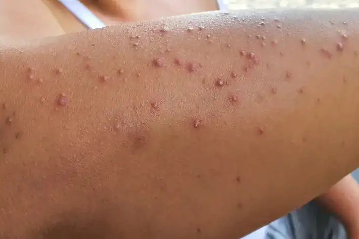 Back and Thigh Acne: Why It Happens and How to Treat It the Right Way