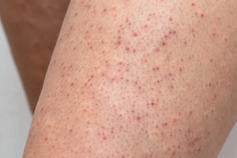 How to Get Rid of Chicken Skin (Keratosis Pilaris) - Riverchase