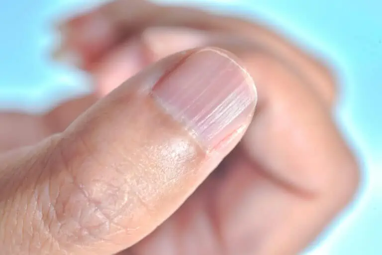 Dr. Kenneth Rodriguez - Apart from hair loss, thyroid disease can cause nail  problems, such as brittle nails or onycholysis (when the nail detaches from  the nail bed, as seen in the