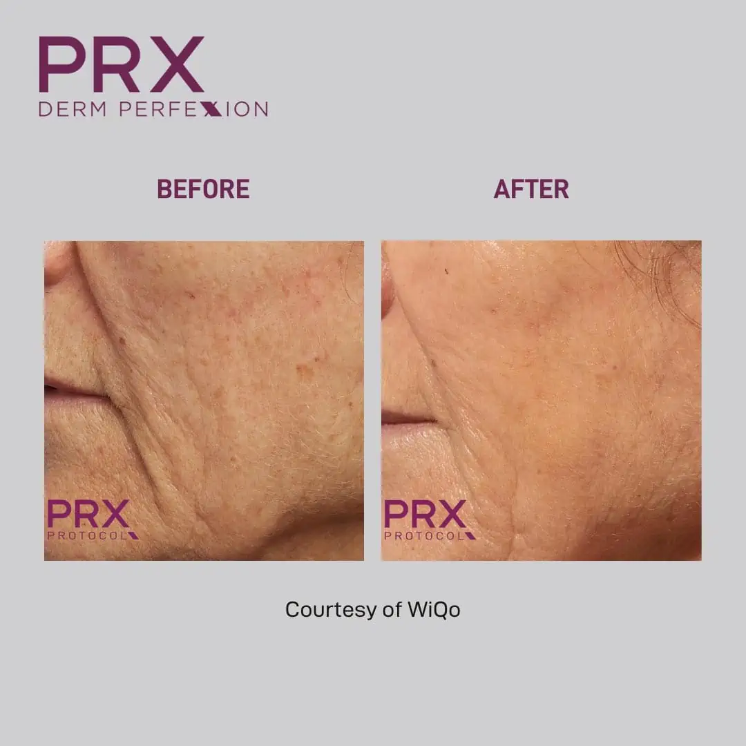 PRX Derm Perfexion Before and After Photo #5