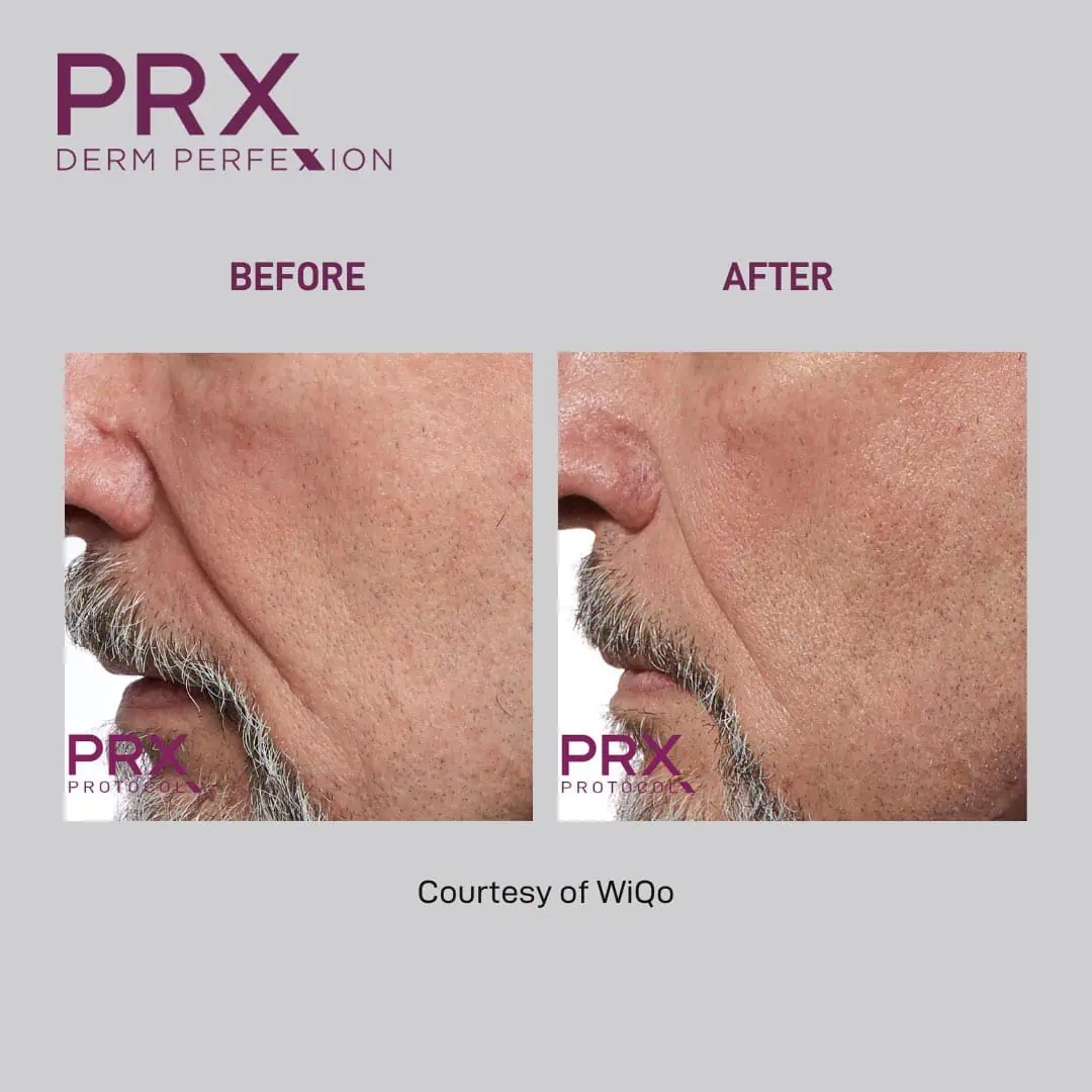 PRX Derm Perfexion Before and After Photo #5