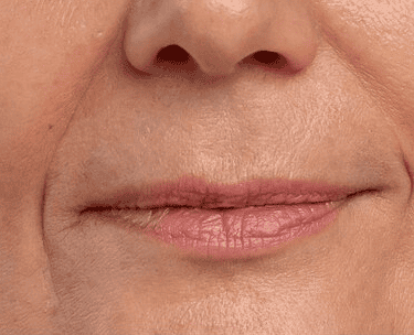 ts-belotero-balance-before