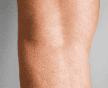 ts-spider-veins-after