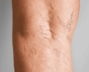 ts-spider-veins-before