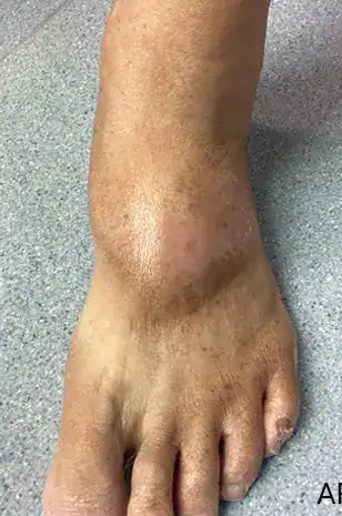 After electron beam therapy, Subject 1