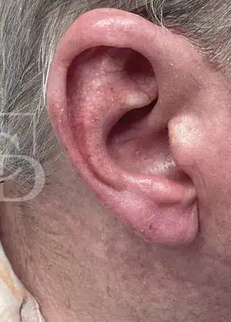 After electron beam therapy, Subject 2