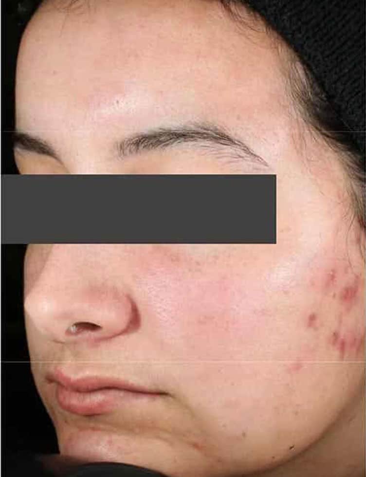 Before Accure Acne Treatment, Subject 4
