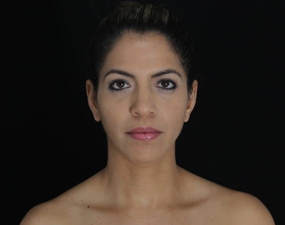 After Belotero Balance & Radiesse treatment, Subject 1