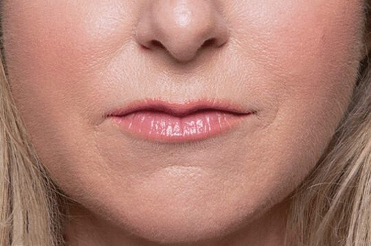 After Belotero Balance & Radiesse treatment, Subject 2